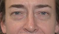 Blepharoplasty Before & After Gallery - Patient 159259 - Image 1