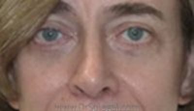 Blepharoplasty Before & After Gallery - Patient 159259 - Image 2