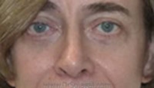 Blepharoplasty Before & After Gallery - Patient 159259 - Image 2