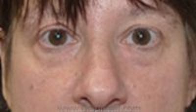 Blepharoplasty Before & After Gallery - Patient 402038 - Image 1