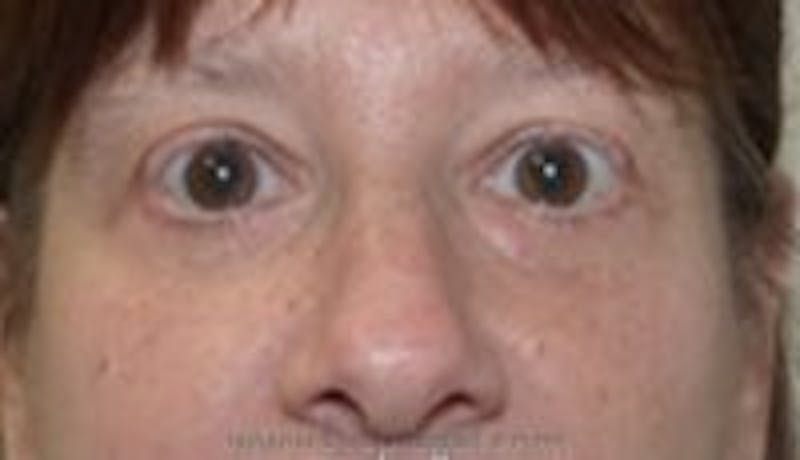 Blepharoplasty Before & After Gallery - Patient 402038 - Image 2