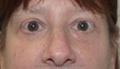Blepharoplasty Before & After Gallery - Patient 402038 - Image 2