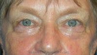 Blepharoplasty Before & After Gallery - Patient 392671 - Image 1