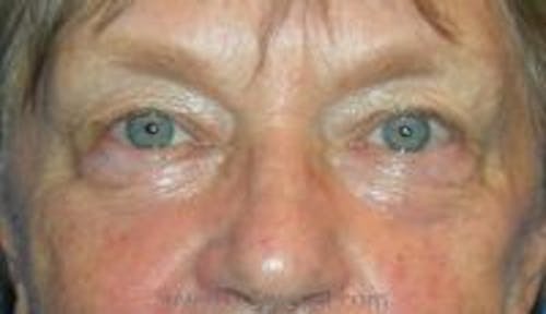 Blepharoplasty Before & After Gallery - Patient 392671 - Image 1