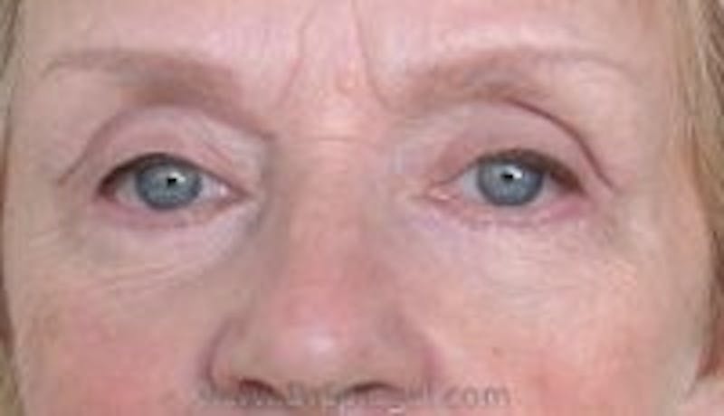 Blepharoplasty Before & After Gallery - Patient 392671 - Image 2