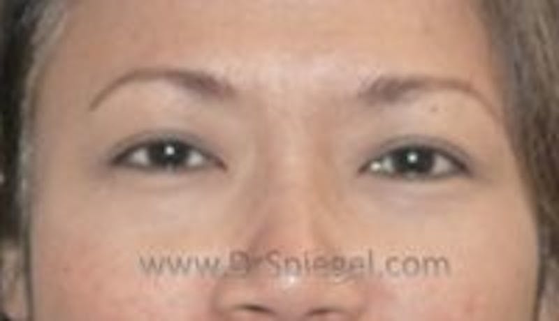 Blepharoplasty Before & After Gallery - Patient 121745 - Image 2