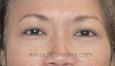 Blepharoplasty Before & After Gallery - Patient 121745 - Image 2