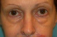 Blepharoplasty Before & After Gallery - Patient 398307 - Image 1