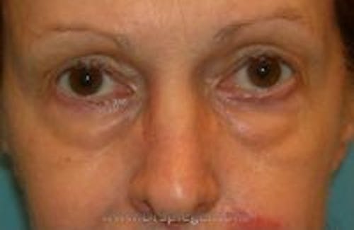 Blepharoplasty Before & After Gallery - Patient 398307 - Image 1