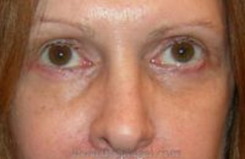 Blepharoplasty Before & After Gallery - Patient 398307 - Image 2