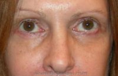 Blepharoplasty Before & After Gallery - Patient 398307 - Image 2