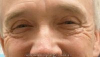 Blepharoplasty Before & After Gallery - Patient 117719 - Image 1