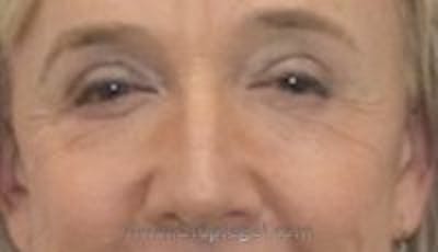 Blepharoplasty Before & After Gallery - Patient 117719 - Image 2