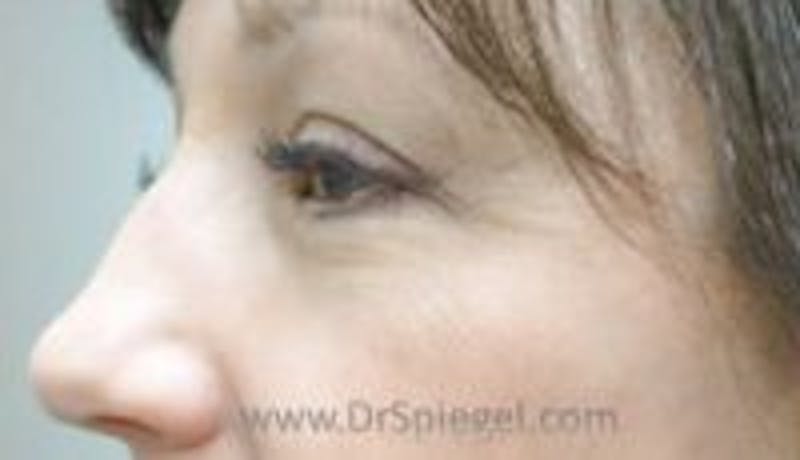 Blepharoplasty Before & After Gallery - Patient 264587 - Image 1
