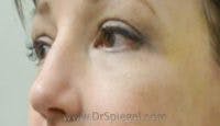 Blepharoplasty Before & After Gallery - Patient 264587 - Image 2
