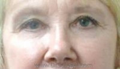 Blepharoplasty Before & After Gallery - Patient 130425 - Image 2