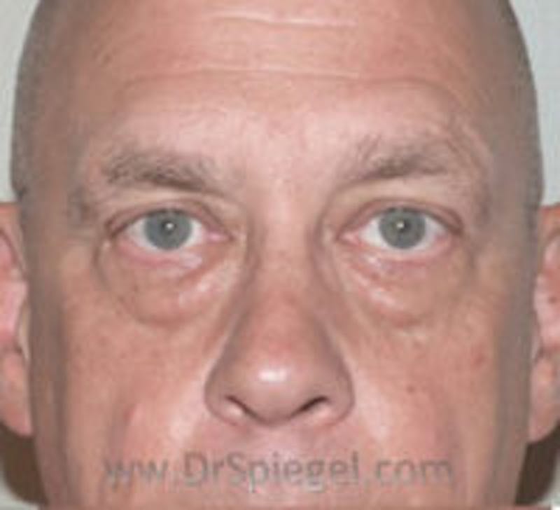 Blepharoplasty Before & After Gallery - Patient 138038 - Image 1