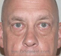 Blepharoplasty Before & After Gallery - Patient 138038 - Image 1