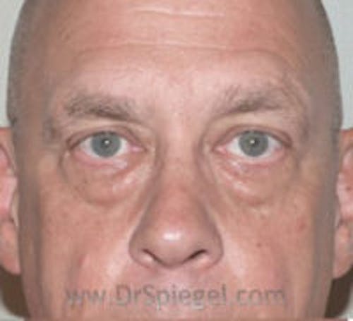 Blepharoplasty Before & After Gallery - Patient 138038 - Image 1