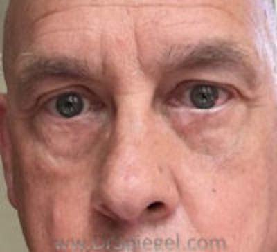 Blepharoplasty Before & After Gallery - Patient 138038 - Image 2