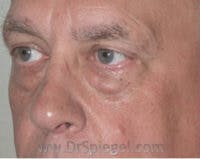 Blepharoplasty Before & After Gallery - Patient 138038 - Image 3