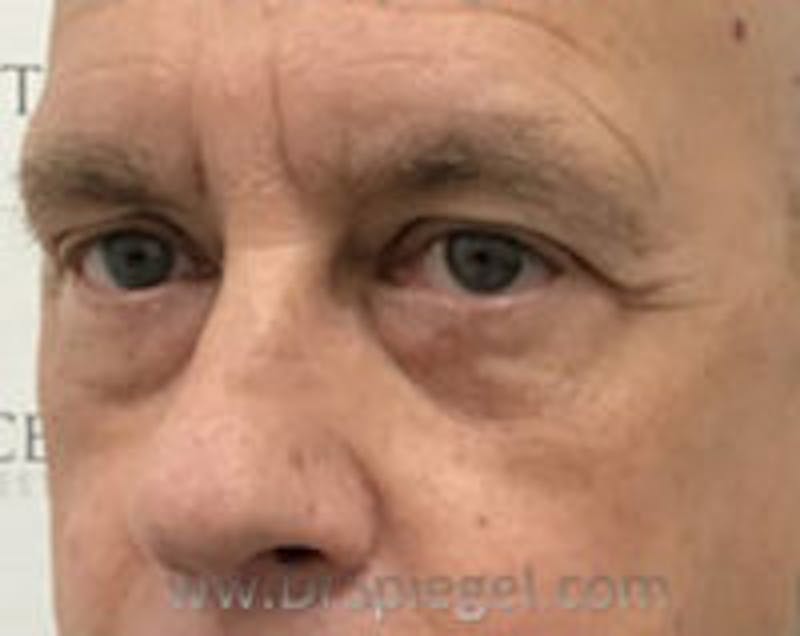 Blepharoplasty Before & After Gallery - Patient 138038 - Image 4