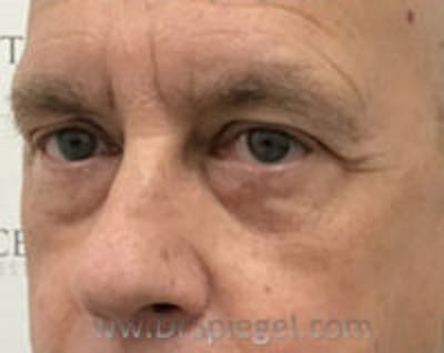 Blepharoplasty Before & After Gallery - Patient 138038 - Image 4