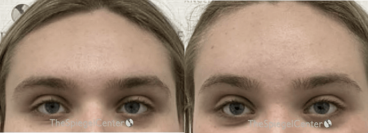 Browlift / Fox Eye Lift Before & After Gallery - Patient 879212 - Image 1