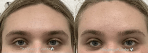 Brow Lift / Fox Eye Lift Before & After Gallery - Patient 879212 - Image 1
