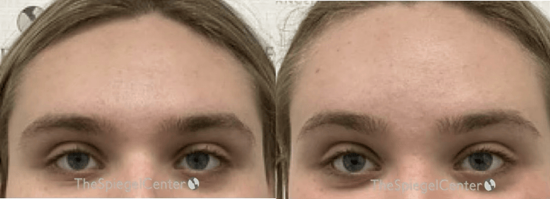 Brow Lift / Fox Eye Lift Before & After Gallery - Patient 879212 - Image 1