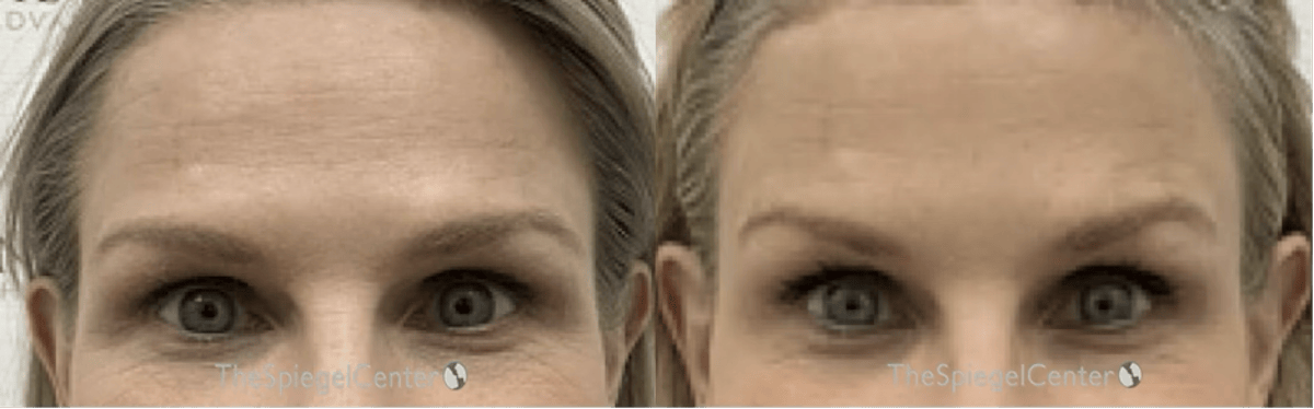 Browlift / Fox Eye Lift Before & After Gallery - Patient 264573 - Image 1