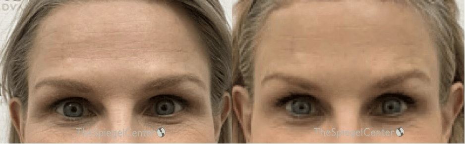 Brow Lift / Fox Eye Lift Before & After Gallery - Patient 264573 - Image 1