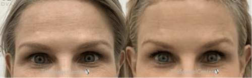 Brow Lift / Fox Eye Lift Before & After Gallery - Patient 264573 - Image 1