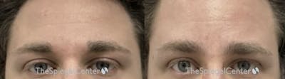 Browlift / Fox Eye Lift Before & After Gallery - Patient 384818 - Image 1
