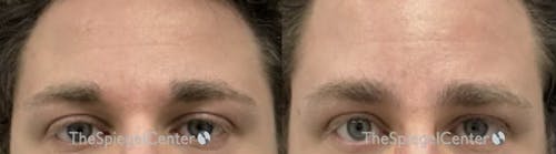 Brow Lift / Fox Eye Lift Before & After Gallery - Patient 384818 - Image 1