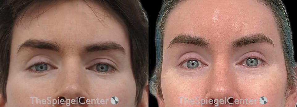 Brow Lift / Fox Eye Lift Before & After Gallery - Patient 156806 - Image 1