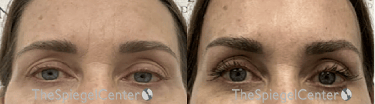 Browlift / Fox Eye Lift Before & After Gallery - Patient 249087 - Image 1