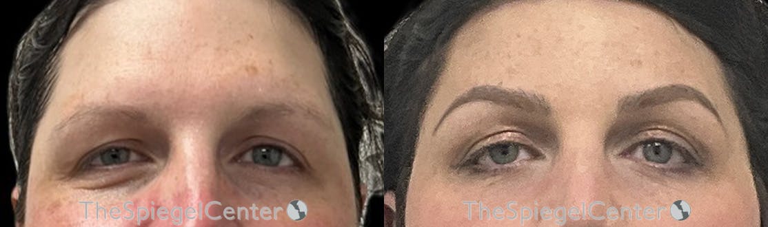 Brow Lift / Fox Eye Lift Before & After Gallery - Patient 186161 - Image 1