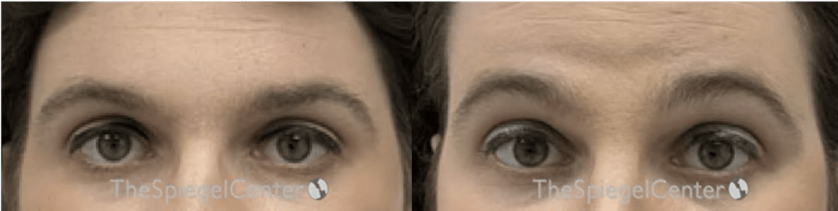 Browlift / Fox Eye Lift Before & After Gallery - Patient 390079 - Image 1