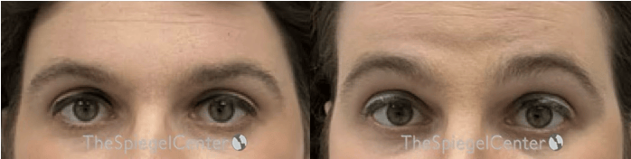 Brow Lift / Fox Eye Lift Before & After Gallery - Patient 390079 - Image 1