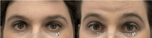 Brow Lift / Fox Eye Lift Before & After Gallery - Patient 390079 - Image 1