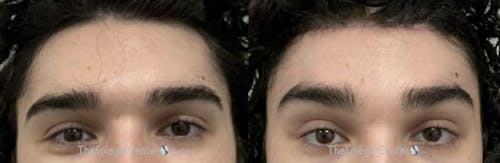 Brow Lift / Fox Eye Lift Before & After Gallery - Patient 490766 - Image 1
