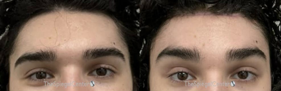 Brow Lift / Fox Eye Lift Before & After Gallery - Patient 490766 - Image 1