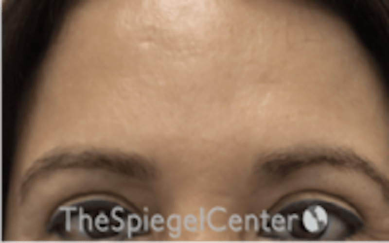 Browlift / Fox Eye Lift Before & After Gallery - Patient 427497 - Image 1