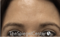Brow Lift / Fox Eye Lift Before & After Gallery - Patient 427497 - Image 1