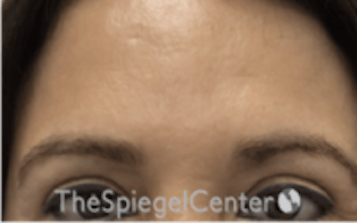 Browlift / Fox Eye Lift Before & After Gallery - Patient 427497 - Image 1