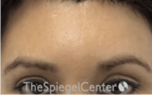 Brow Lift / Fox Eye Lift Before & After Gallery - Patient 427497 - Image 2