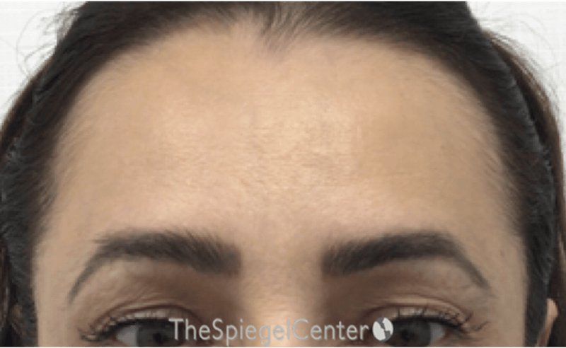 Browlift / Fox Eye Lift Before & After Gallery - Patient 245474 - Image 1