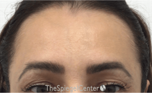 Brow Lift / Fox Eye Lift Before & After Gallery - Patient 245474 - Image 1
