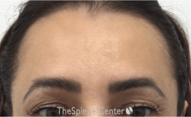 Brow Lift / Fox Eye Lift Before & After Gallery - Patient 245474 - Image 1